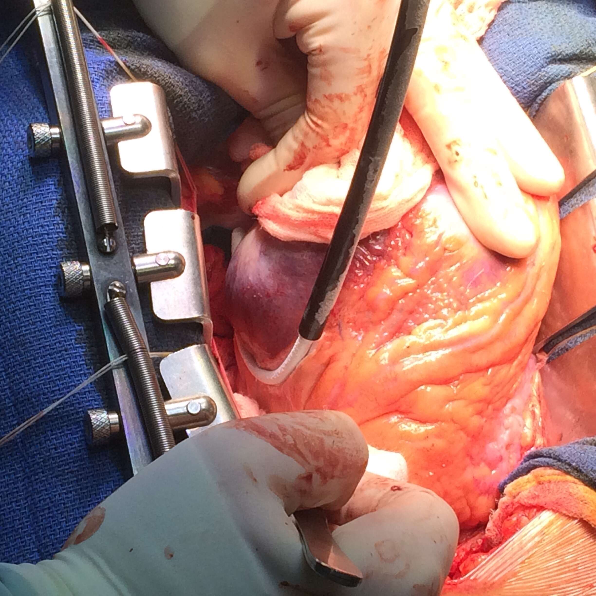 epicardial surgery cryoablation